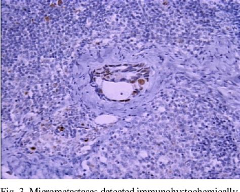 Figure From Significance Of Sentinel Lymph Node Biopsy Labeled By