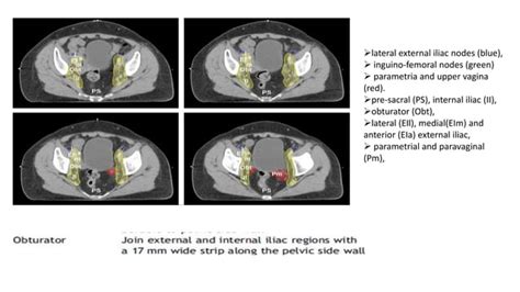 Ebrt In Carcinoma Cervix