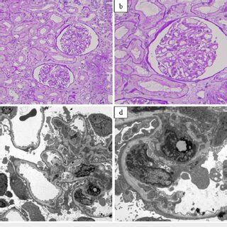 Renal Pathology Findings Of Light And Electron Microscopy A Light