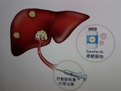 口服標靶藥服栓塞治療 可提高肝癌晚期患者存活率 自由健康網