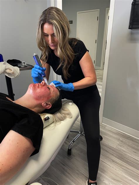 Microneedling With Platelet Rich Plasma PRP Therapy In Woodbury