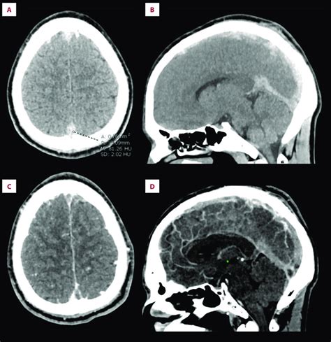 Unenhanced Ct Brain And Contrast Enhanced Ct Venography A Axial And