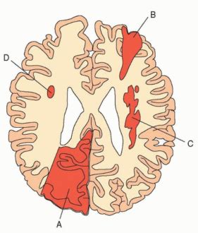 Hemiballismus Definition, Symptoms, Causes, Treatment