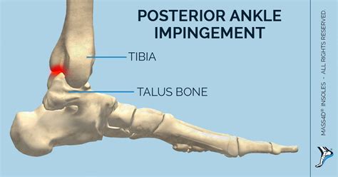 What Is Posterior Ankle Impingement Syndrome Mass4d® Foot Orthotics