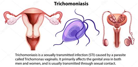 Infografía De Tricomoniasis Con Ilustración Explicativa 2023