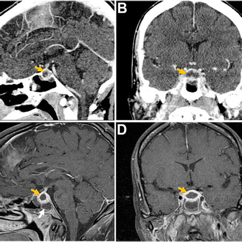 Initial Contrast Enhanced Head Computed Tomography Reformatted Sagittal