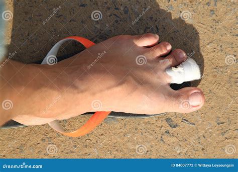 Foot Ulcers Stock Photo Image Of Sand Ulcers Foot 84007772