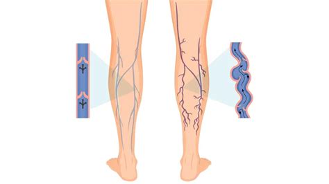 Varicose Veins Everything You Need To Know