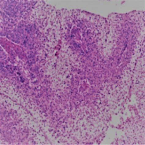 Stratified Squamous Epithelium Exhibiting Papillary Projections With