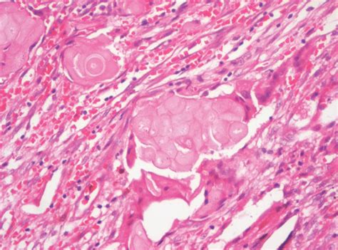 A Thick Cystic Tumor Wall Showing Loose Mature Connective Tissue