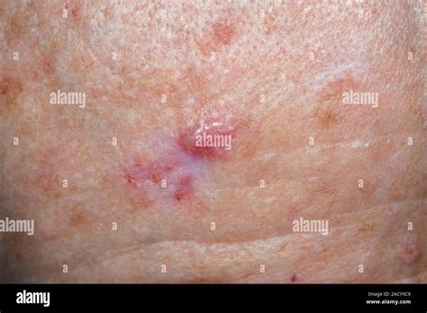 Skin Cancer Close Up Of A Basal Cell Carcinoma Skin Cancer On The