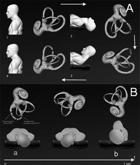 Yacovino Repositioning Manoeuvre For Anterior Canal BPPV A During