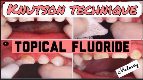 Knutson Technique Ii Method Of Application Of Neutral Sodium Fluoride