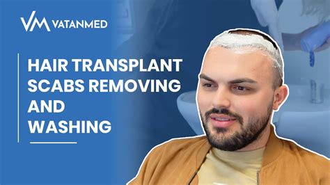 Hair Transplant Scabs Removing And Washing VATANMED YouTube