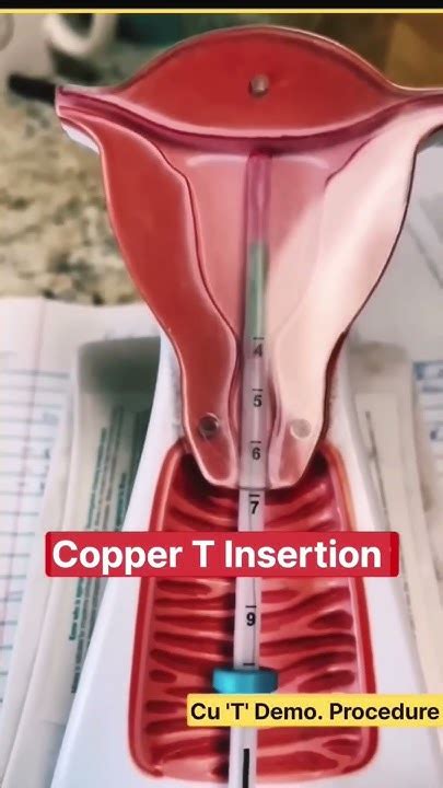 Iud Insertion Copper T Insertion Copper T Procedure Iud Gynocology Vagina Medical