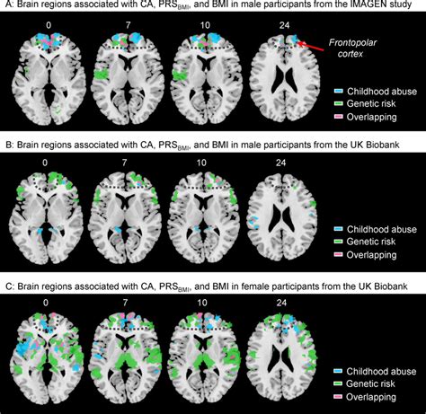 Brain Regions Associated With Childhood Trauma Genetic Risk For Higher