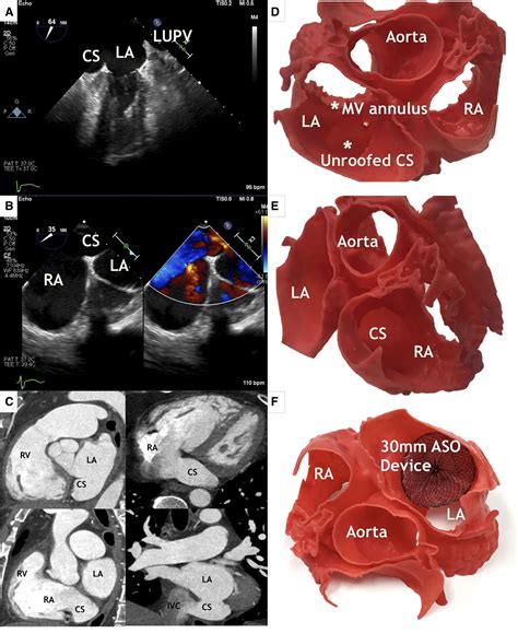 Using A 3 Dimensional Printed Model To Plan Percutaneous Closure Of An