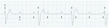 Emergency Medicine Educationecg Pointers 7 Cant Miss Ecg