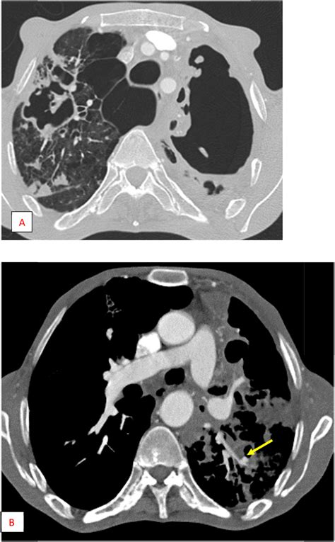 Case 2 A Ct Lung Window Left Upper Lobe Destroyed Emphysema Bubbles