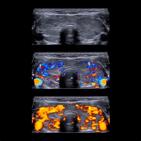 Graves Disease Thyroid Ultrasound