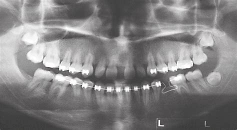 Scielo Brasil Orthodontic Treatment In Patient With Idiopathic Root