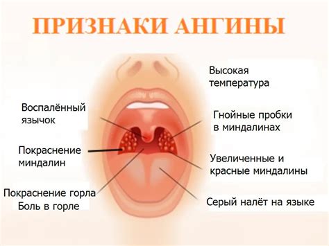 Отек гортани: как снять отек горла? Лечение и симптомы