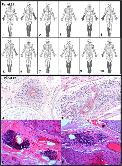 Clinico Pathological Presentations Of Mm Associated With Sle Panel 1