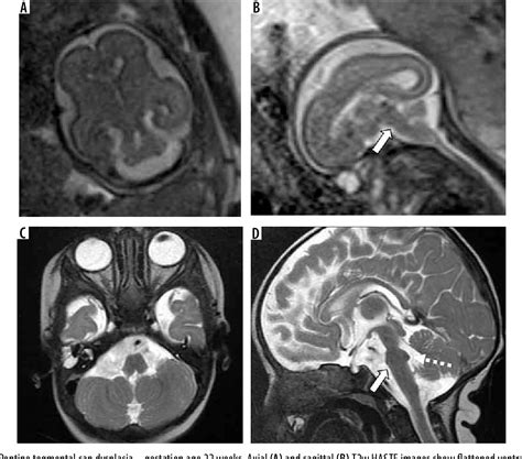 Figure 14 From Imaging Spectrum Of Posterior Fossa Anomalies On Foetal