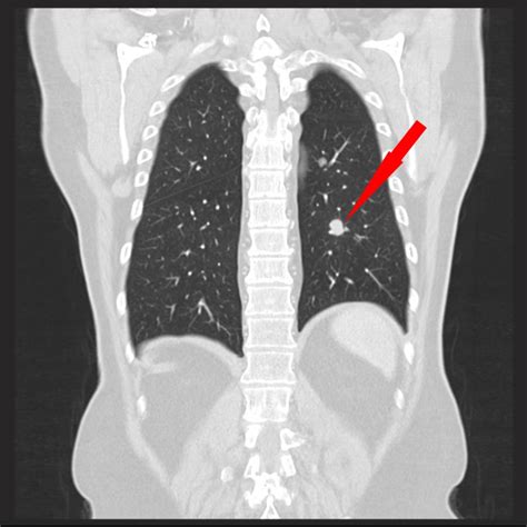 Ct Vorsorge Lunge Brustkorb Radiologie Zentrum Neu Ulm