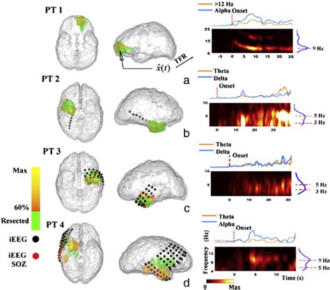 Figure 3 From Dynamic Imaging Of Ictal Oscillations Using Non Invasive