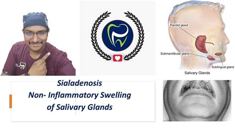 Dr Rudra Mohan Painless Swelling Enlargement Of Salivary Glands