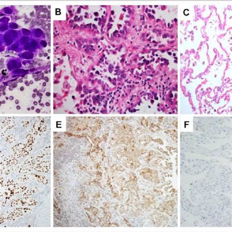 A Cytology Fine Needle Aspiration Fna Findings Of The Patients Download Scientific