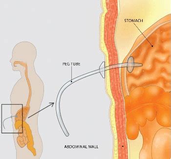 Understanding Percutaneous Endoscopic Gastrostomy Gastroenterologist