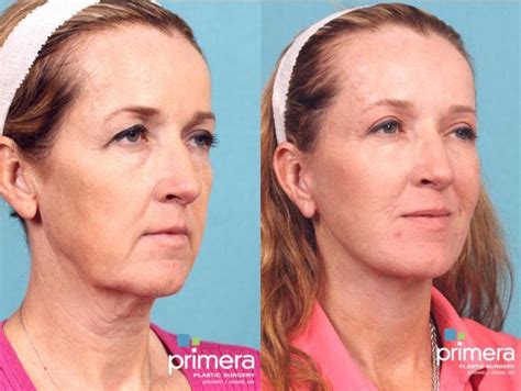 Neck Lift Before And After Pictures Case 496 Orlando Tampa Florida