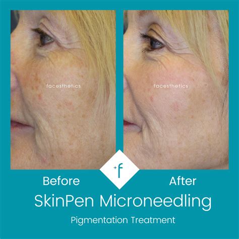 Skinpen Microneedling Leeds And Wakefield Facesthetics