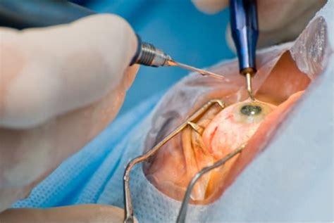 Cataract Surgery Linked With Lessened Dementia Risk Bionews Central