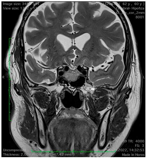 Medicina Free Full Text Magnetic Resonance Imaging Features Of The Sphenoid Sinus In