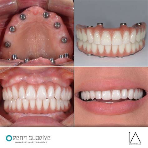 Upper zirconia implant bridge – Artofit