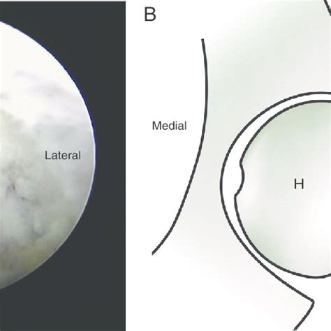 A Intraoperative Image Of Hip Arthroscopy For Subcapital Download