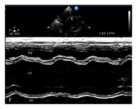 Echocardiograms In D And M Mode During Induction Of Aicm