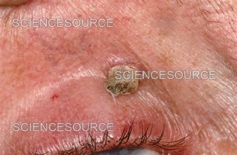 Cutaneous Horn