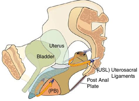 Diagram Of Uterosacral Ligaments