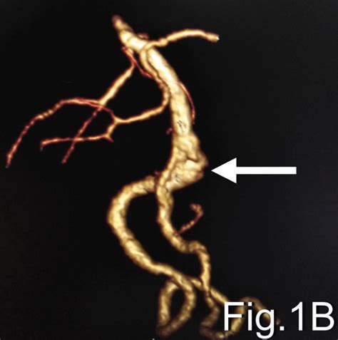 Ac Show The Mra Cta And D Dsa Respectively Of Basilar Artery