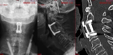 Anterior Cervical Corpectomy And Fusion ACCF Joshua Li MD PhD