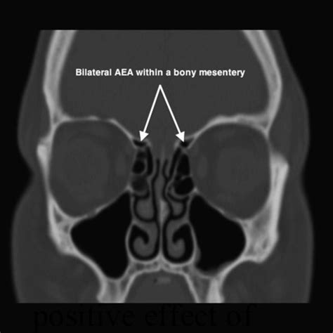 Endoscopic anatomy of the right anterior ethmoid artery. AEA = anterior ...