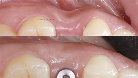 Soft Tissue Management Around Dental Implants Miami Institute