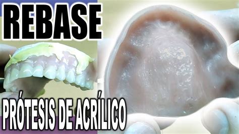 C Mo Hacer Un Rebase A Una Pr Tesis Dental De Acr Lico Paso A Paso