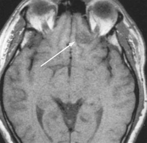 Fibrous Dysplasia Involving The Base Of The Skull Ajr