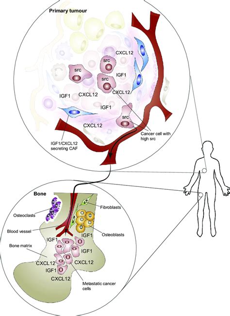 Cancer associated fibroblasts can select cancer cells primed to thrive ...