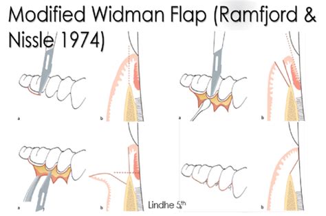 Flap Techniques In Dentoalveolar Surgery Intechopen Off